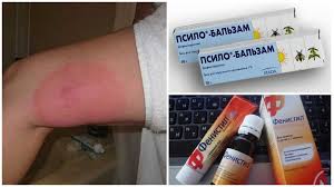 Discuții despre muscatura de tantar. Ce Trebuie FÄƒcut DacÄƒ Un È›anÈ›ar A MuÈ™cat È™i Un Picior Sa Umflat