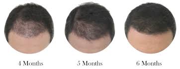 That same amount of growth in a hairstyle that is even 4 inches long becomes barely notable by comparison. Hair Growth Period Hair Deluxe Clinic En