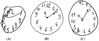 Moca scores range between 0 and 30. Three Examples Of Clock Drawing Test Cdt Using Rouleau Et Al S Download Scientific Diagram