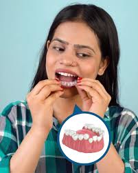 Family 1st Dental of South Sioux is proud to offer clear braces to our  patients. During treatment, you will use a series of custom-made, clear  aligners that gradually shift teeth into place