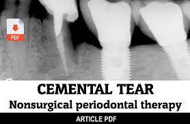 Development mechanism of cemental tears is not completely elucidated, but. Pdf Cemental Tear A Case Report With Nonsurgical Periodontal Therapy