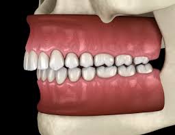 Jun 24, 2021 · before and after photos showing underbite correction, overbite correction, open bite correction, and bite correction with jawtrac and venlay restorations. Overbite Underbite And Crossbite What Do These Bite Disorders Mean