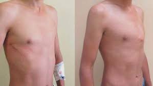 It also gives shape and support to other parts of your body, such as your ears, nose and windpipe. Pediatric Orthopedics Pectus Carinatum Pectus Carinatum Introduction Diseases And Conditions Pediatric Oncall