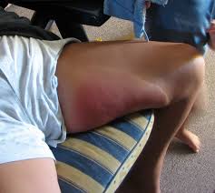Wann sie nach dem stich zum arzt gehen sollten es sei normal, dass die haut nach stichen von bienen, wespen oder hornissen stark anschwelle. Datei Wespenstich 2005 07 29 Jpg Wikipedia