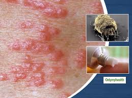Image result for scabies effects on the human body