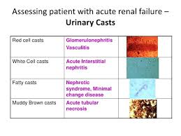 Urinary Casts Nephrotic Syndrome Medical Laboratory Science Acute Renal Failure