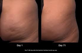 Just to let you know, i'm not an expert so. Best Velashape Specials Near Me Nj Cellulite Removal Price Cost