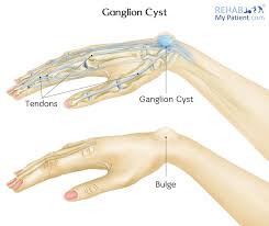 Shape and size.ganglion cysts are round or oval and usually measure less than an inch (2.5 centimeters) in diameter. Ganglion Cyst Of The Wrist And Hand Rehab My Patient
