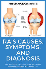 Rheumatoid Arthritis In Icd 10 Cm It S All In The Joints Medical Coding Buff