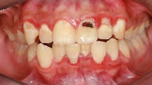The harm of alcohol and tobacco concept. Rotten Teeth Do Gooder