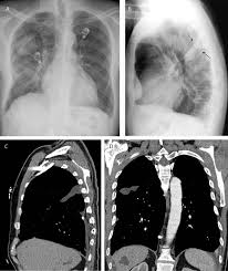 Pleural fluid/serum ldh ratio >0.6. Loculated Pleural Effusion Lateral Decubitus Pleural Effusion X Ray Findings The American Thoracic Society Delineates Three Progressive Kenneth Erhardt