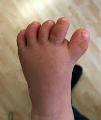 Image result for Hallux Varus