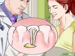 Now the time i'm noting is the actual working time. How To Prepare For A Cavity Filling With Pictures Wikihow