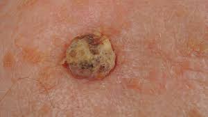 Cartoon vector illustration skin cancer on scalp stock illustrations. What Is Cutaneous Squamous Cell Carcinoma Symptoms Causes Diagnosis Treatment And Prevention Everyday Health