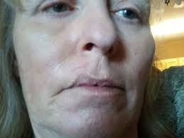 Dr Marc Salzman for Laser Resurfacing