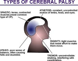 Pin By Pediastaff On Cerebral Palsy Types Of Cerebral