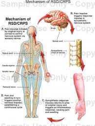 I Suffer From This Disease My Son Has Crohns Disease Anyone Ever Wanna Contact Me Im Misa Blessed Lopez Co Crps Crps Awareness Chronic Fatigue Syndrome Diet
