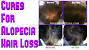 Female Hair Loss Treatment