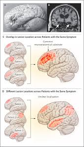 Image result for Neurologic Lesion Localization