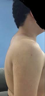 A buildup of fat between the shoulder blades causes a hump in the back of the neck to form. Hi Am 20 Years Old I Became Insecure About Myself Because Of The Neck Hump And Weight Gain During Covid Lockdown I Will Go To A Gym And Try To Lose Some