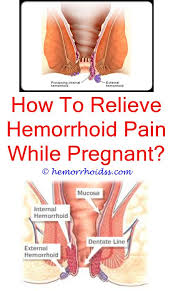 How To Get Rid Of Hemorrhoids Naturally Fast And Easy Hemorrhoids Treatment Getting Rid Of Hemorrhoids Bleeding Hemorrhoids