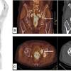 Prostate cancer is the most common type of cancer in men after skin cancer. 1