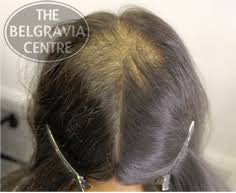 It is caused by fluctuations in hormones, and typically manifests as men and women age. Hair Loss In Women A Guide