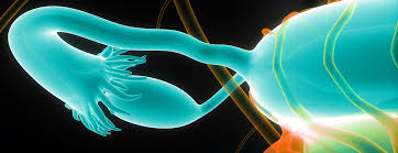 Ovarian cancer may cause several signs and symptoms. Taking Charge What Is Ovarian Cancer Ucsf Health
