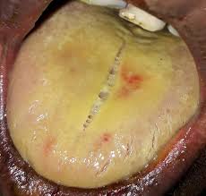 Image result for yellow tongue infection