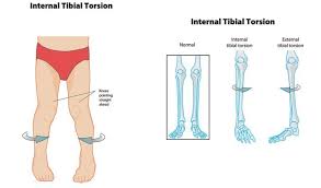 Image result for In-Toeing