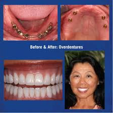 Maybe you would like to learn more about one of these? Implant Supported Over Dentures Hybrids Wellington Fl Wellington Center For Laser Dentistry