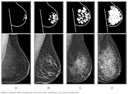 What does breast cancer look like on a mammogram? Dense Breast Tissue What It Means To Have Dense Breasts Mayo Clinic