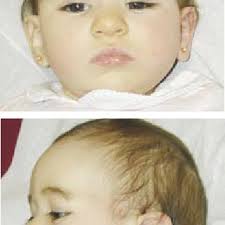 PDF) A female infant with hypotonia, developmental delay, transitional  hearing loss and 22q13.1 deletion