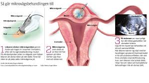 Myom terminolojisi tıbbi literatürde fibroid, uterin fibroid, leiomyoma, myoma uteri gibi isimler verilen myomlar, içlerinde düz kas ve bağ dokusu içeren iyi huylu (kanser olmayan) kitlelerdir. Varldsunik Studie Om Myom Danderyds Sjukhus Ab