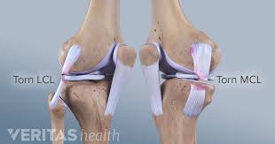 Needs evaluation by rheumatologist to assess how much instability and perhaps by a physical medicine specialist or neurologist. Symptoms Of Mcl Sprains And Tears