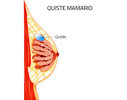 Nodulos Mamarios Tratamiento Y Cuando Sospechar Cancer