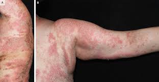 Image result for Pustular Psoriasis
