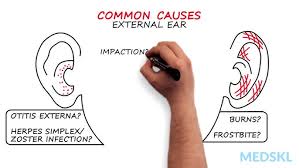 Image result for Otalgia