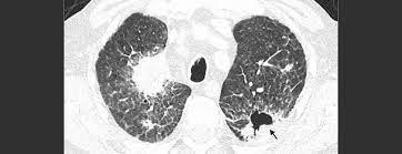 Mucormycosis, also known as black fungus, is a serious fungal infection, usually in people with reduced ability to fight infections. Pulmonale Mukormykose Swiss Medical Forum