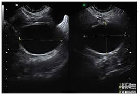 They are common and usually form during ovulation. The Characteristic Ultrasound Features Of Specific Types Of Ovarian Pathology Review