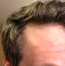 Forums // hair discussions, alopecia treatments, hair repair and replacement. Start Finasteride Avodart Or Wait And Get A Transplant Advice Needed Hair Loss Drugs Hair Restoration Network Community For And By Hair Loss Patients