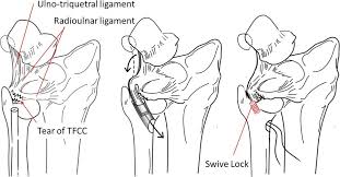 Forced ulnar deviation and positive ulnar variation carry associations with injuries to the tfcc. New Tfcc Reconstructive Technique Using Ulnotriquetral Ligament For The Ulnar Foveal Tear Of Tfcc Journal Of Hand Surgery