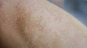 Image result for Pigment stains on the shin