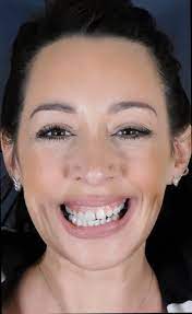The official glasgow smile music video for smile camera: Digital Smile Design Case Studies Glasgow Smile Clinic