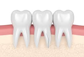 Image result for Tooth Fracture