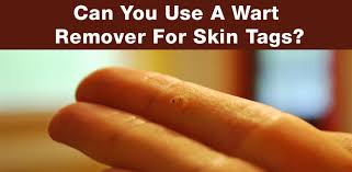 Wart removal treatments covered are both doctor/clinic options as well as home remedy. Can You Use A Wart Remover For Skin Tags Getting Rid Of Skin Tags