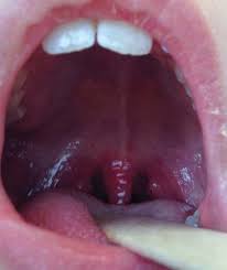 Image result for Strep throat infection roof of mouth