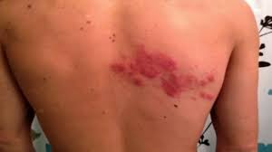 Corak dekor ini biasanya berupa tumbuhan, hewan dan manusia gambar dekoratif dapat dibedakan menjadi dua bentuk atau jenis, yaitu: Kayap Pusing Satu Badan Boleh Menyebabkan Kematian Ke The Diagnosa