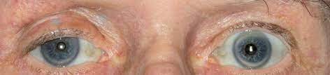 In contrast with hyperhidrosis, which is a socially troubling yet often benign condition, the consequences of untreated hypohidrosis include hyperthermia, heat stroke and death. Uncommon Cause Of Horner S Syndrome Bmj Case Reports