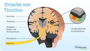 Ursachen Von Tinnitus Mit Schaubild Erklart